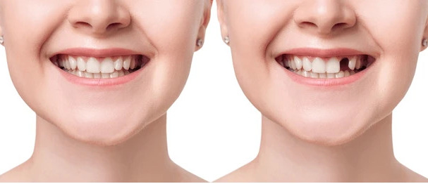 Laser tooth filling and aesthetic restoration