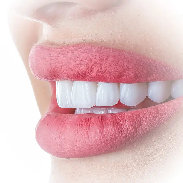 Orthodontic braces and professional teeth whitening