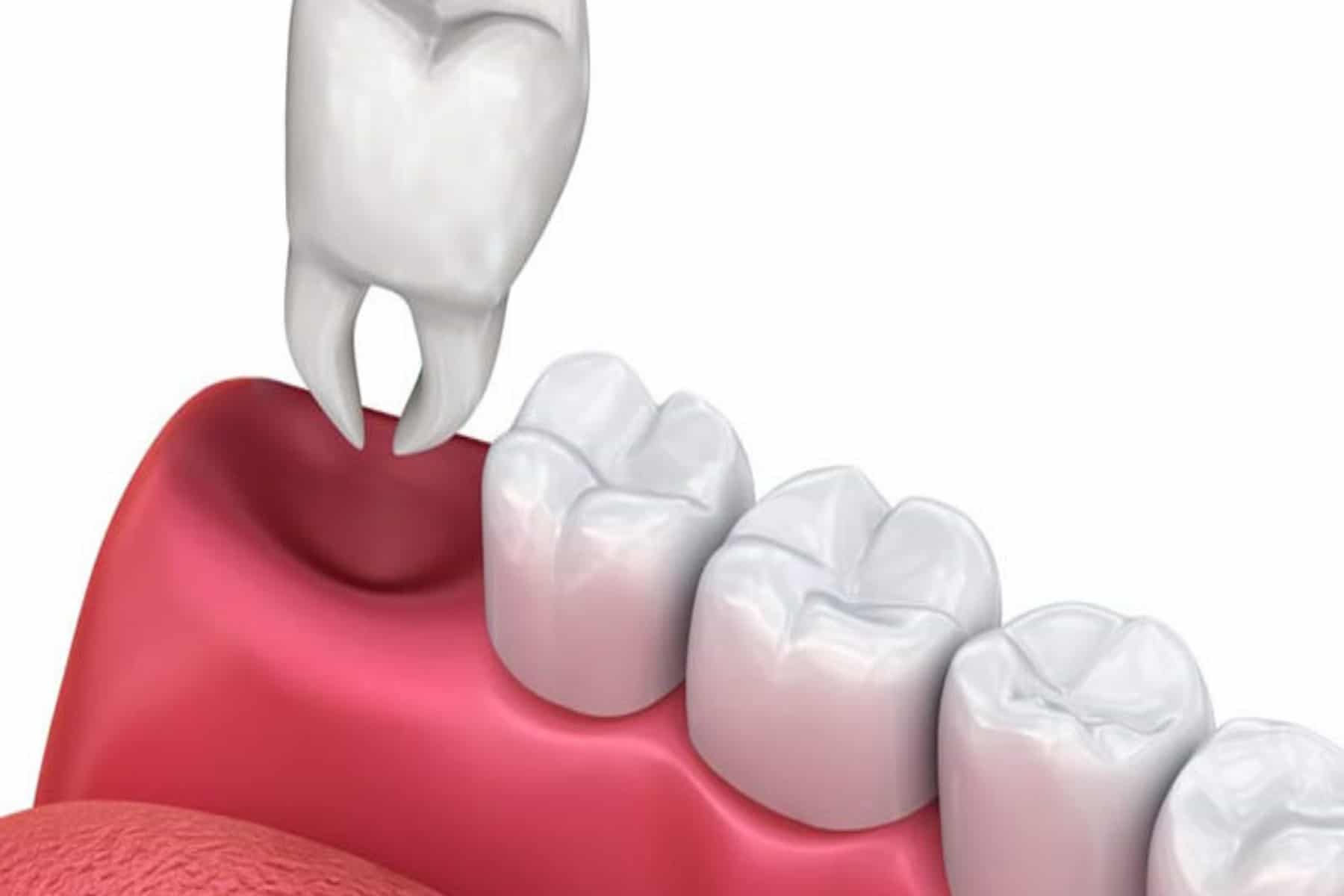 Painless tooth extraction and oral surgery